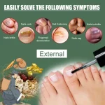 Ying59 Nail Fungal Treatment Essence Oil Foot Toe Nail Fungus Removal Serum 7 Days Repair Onychomycosi Anti Infection Gel Care - Image 3